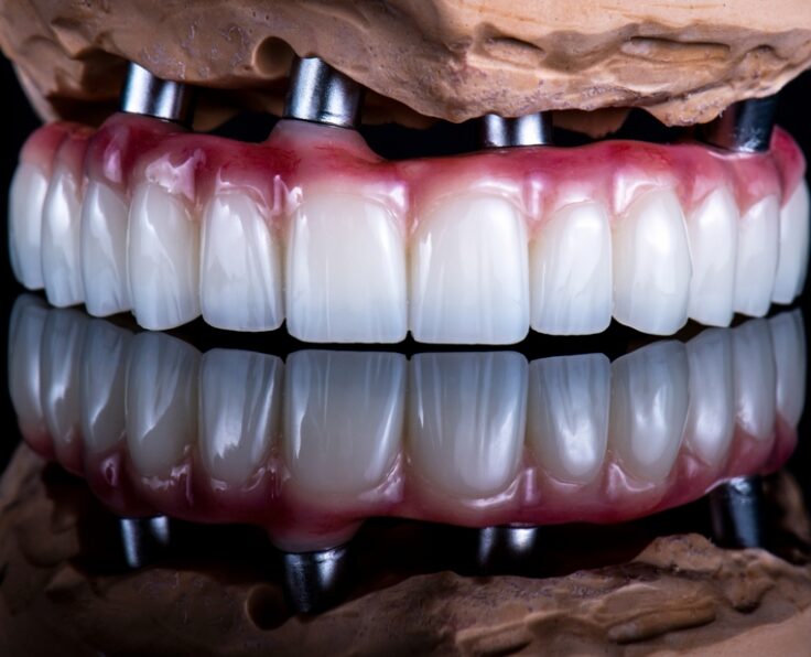Dental,Photography,Of,Full,Arch,Zircon,Bridge,On,Implants