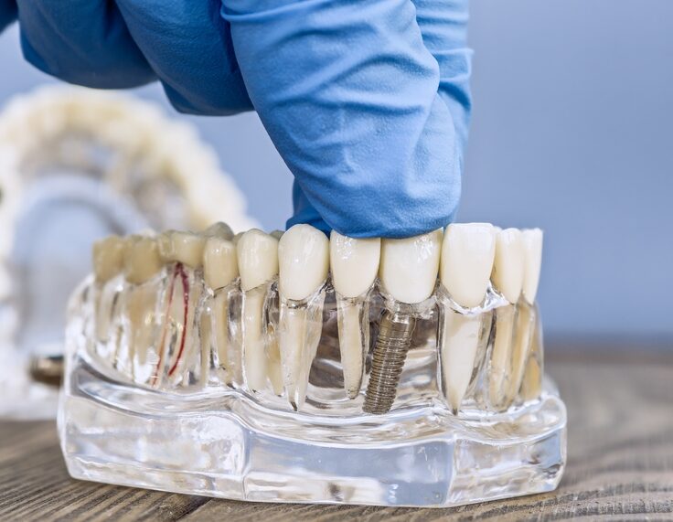 Close-up,Of,A,Transparent,Dental,Implant,Model,With,A,Gloved
